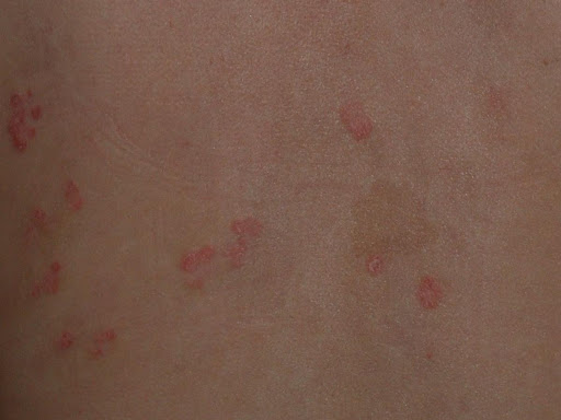 舌の乾癬の兆候と症状