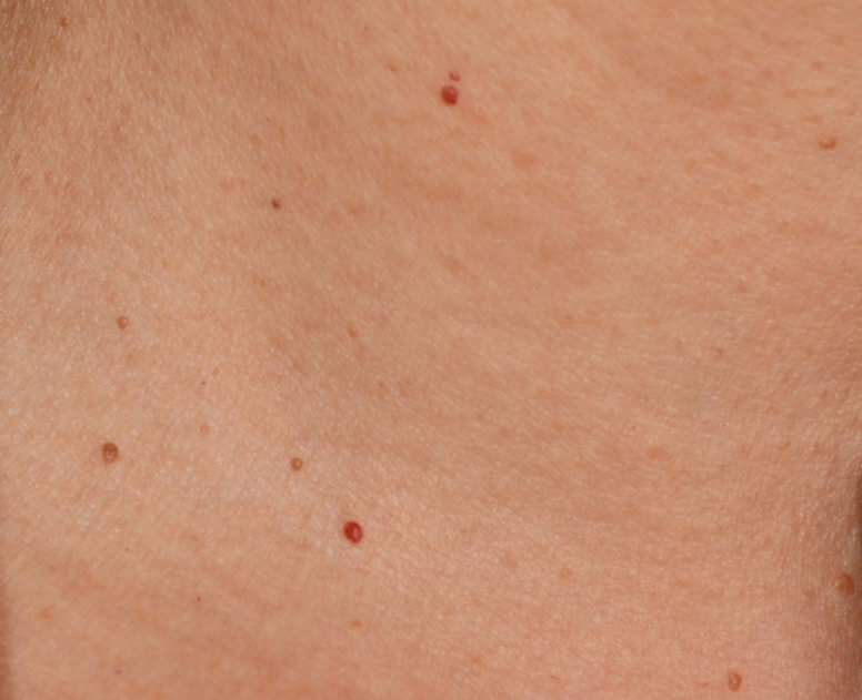 点状出血を予防する方法