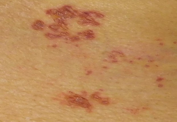 4. クリーム、ローション、パッチの使用を検討する