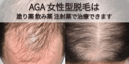 AGA 女性型脱毛は塗り薬飲み薬で治療できます