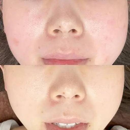 ダーマV症例画像