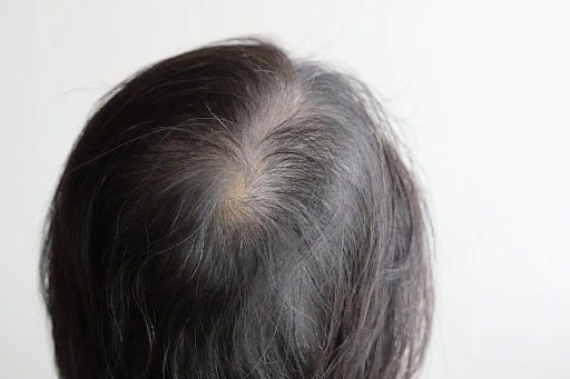 ミノキシジル外用薬の効果を高めるために