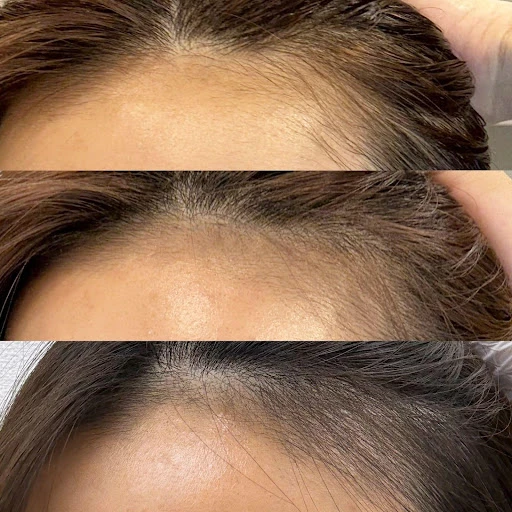 女性型脱毛にミノキシジル外用薬を使用した症例