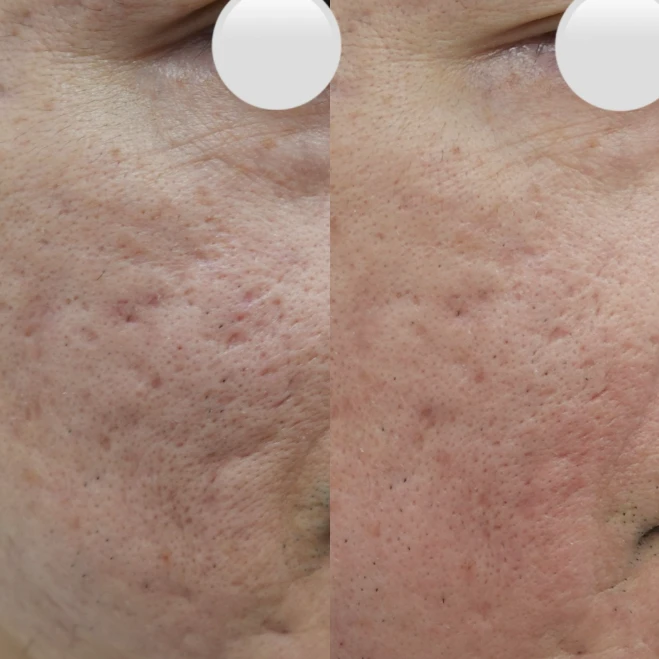 リトゥオの症例画像