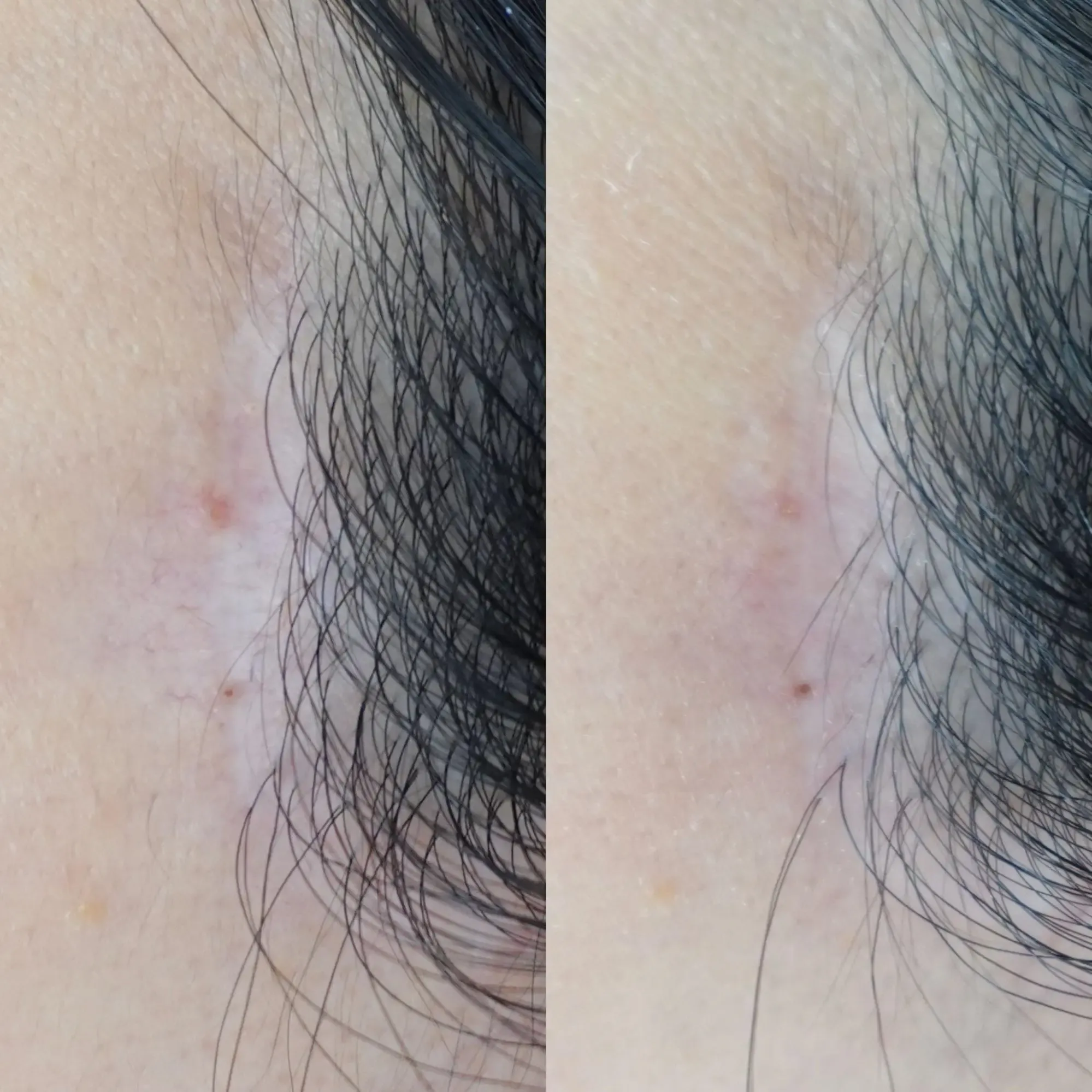 術後のへこみに対する当院での症例