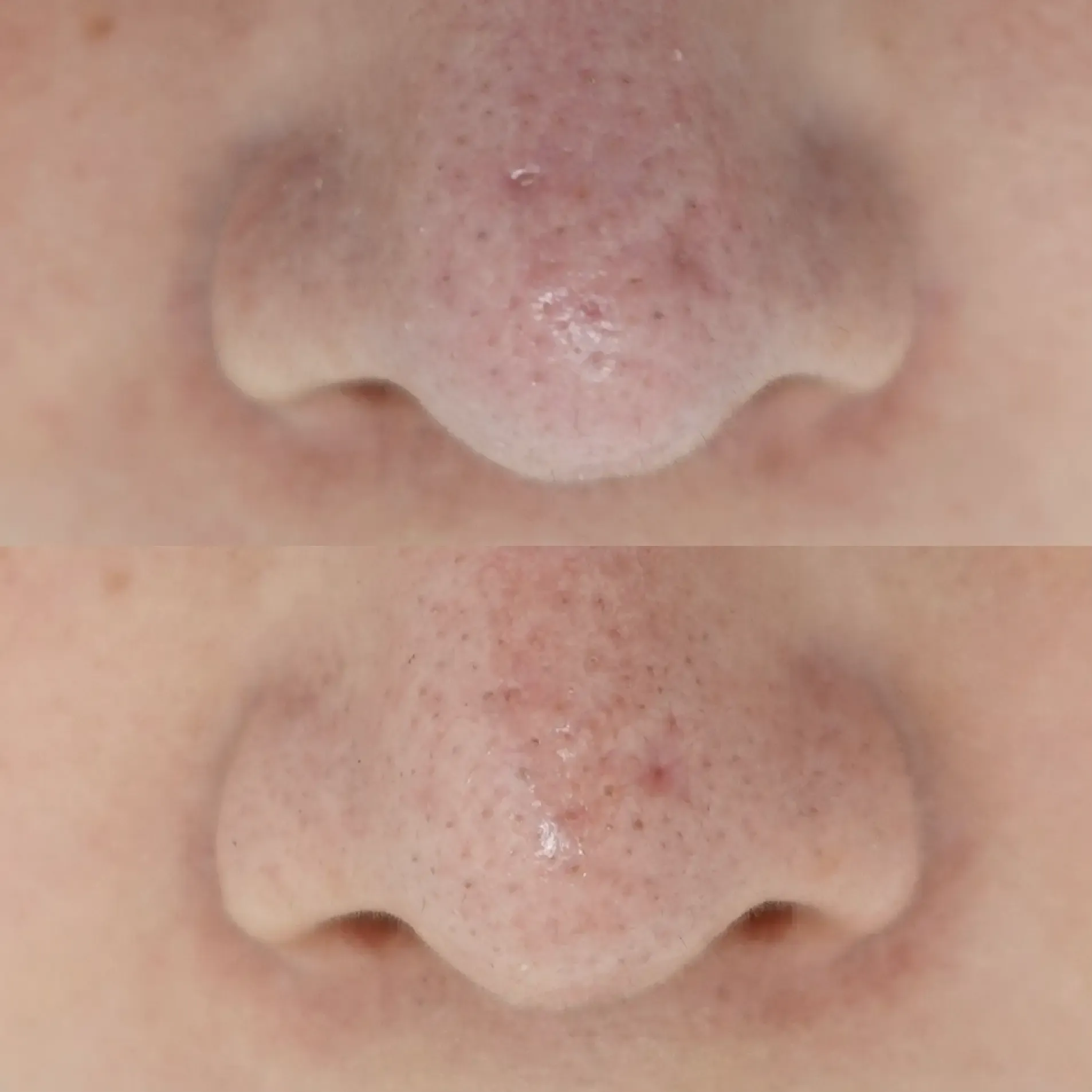 アイスピック型瘢痕に対する当院での症例