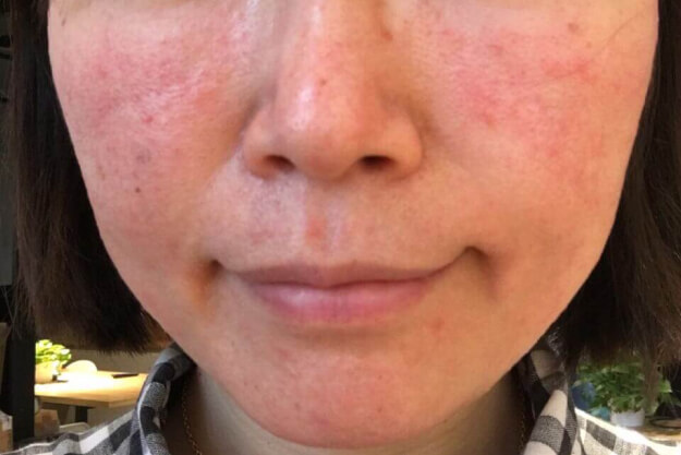 日光アレルギー顔