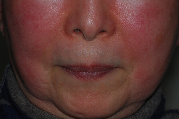 顔の赤み、毛細血管拡張の症状例