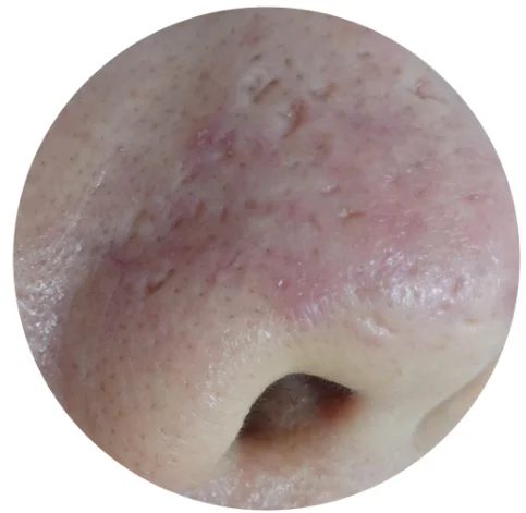 アイスピック型