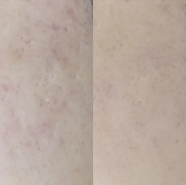 トライフィルプロ症例画像