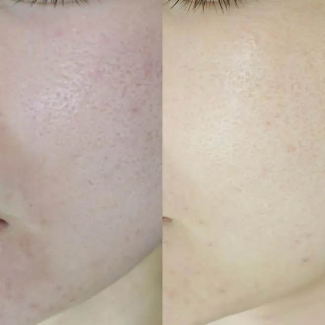 毛穴に対する当院での症例２ 写真1