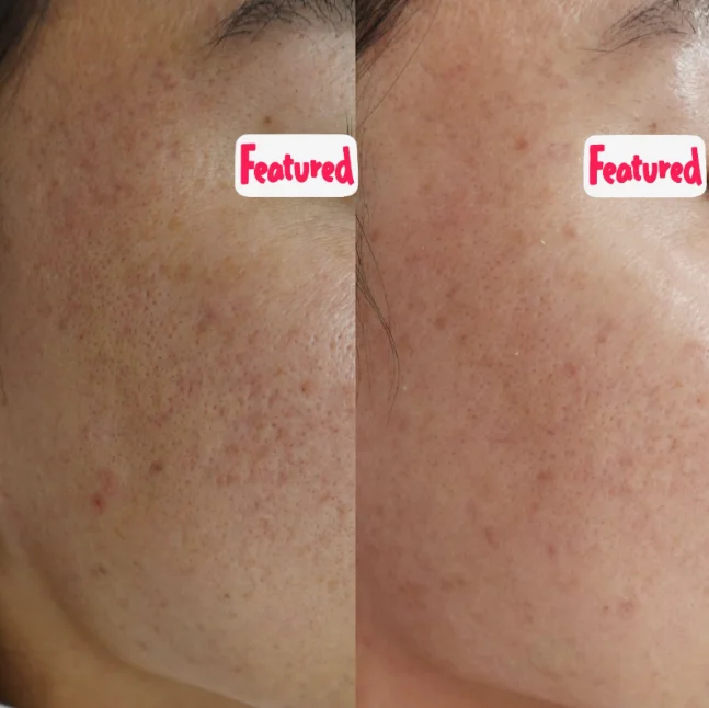 ニキビ跡のへこみに対する当院での症例3 写真1