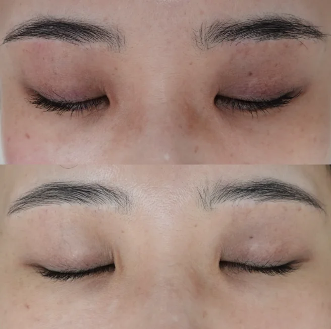 目の周りの色素沈着に対する症例