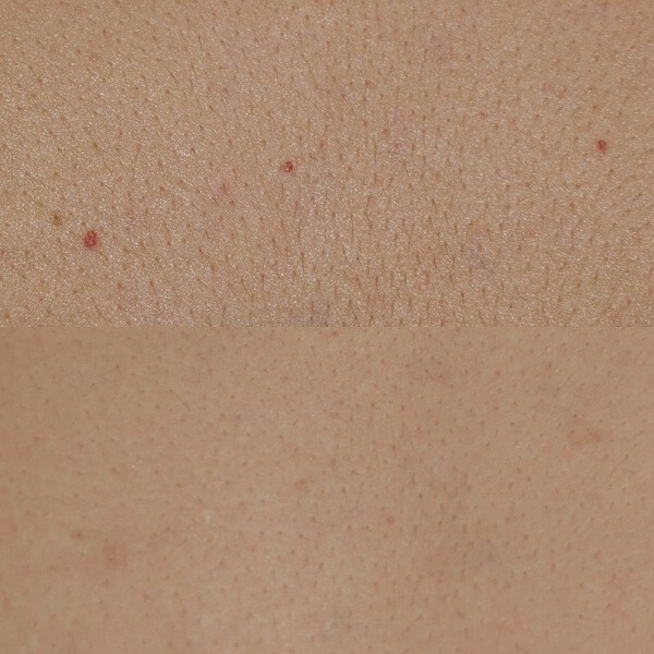 老人性血管腫（赤ほくろ）のVビームの治療　症例