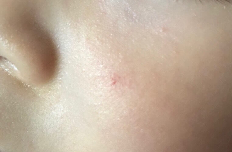 くも状血管腫