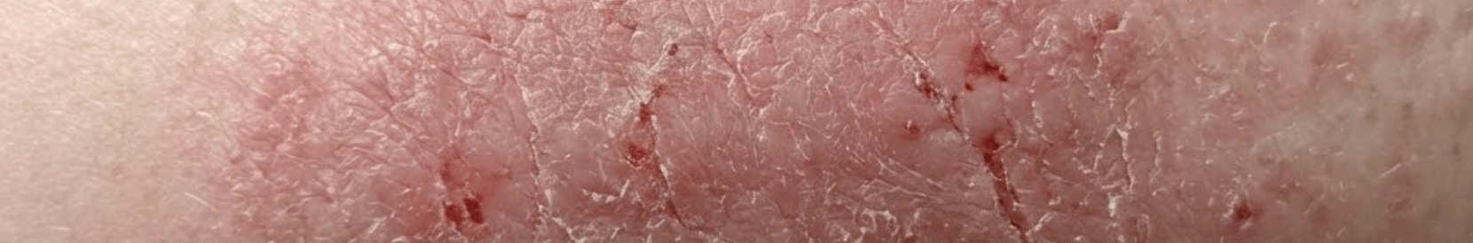 アトピー性皮膚炎