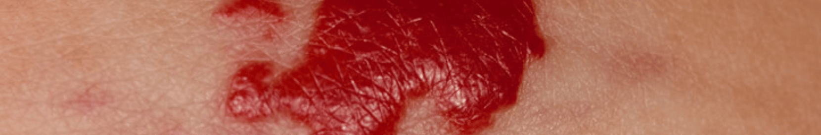血管腫