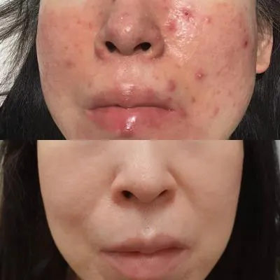 重症酒さに対してイソトレチノイン治療を行った症例