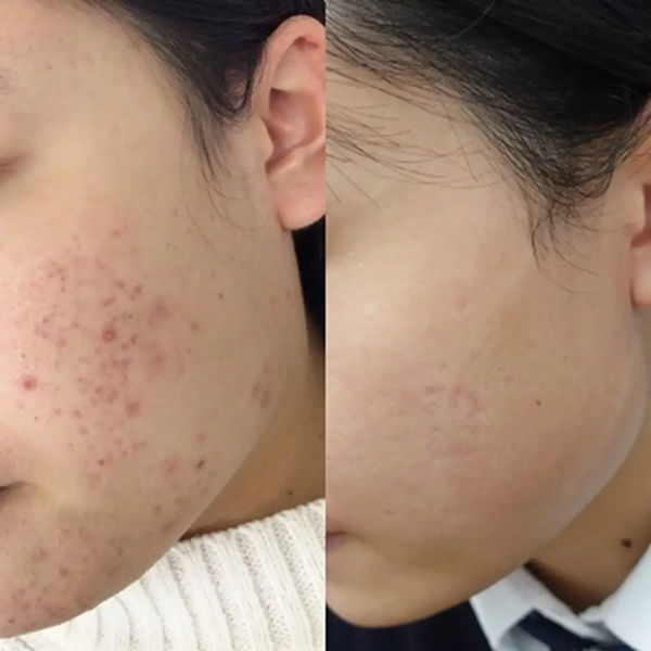 5年以上保険適応の塗り薬や飲み薬で治らないとニキビでお悩みだった10代女性の症例