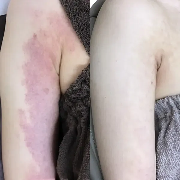 Vビームにより単純性血管腫にアプローチした症例