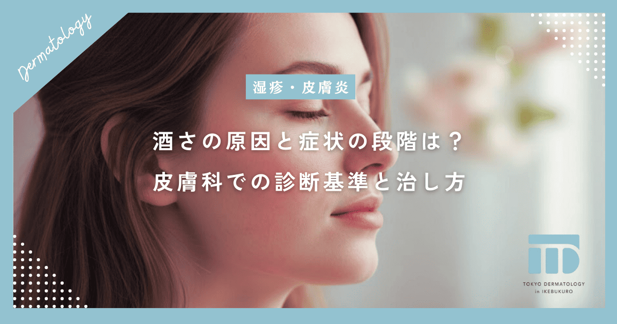 酒さ(赤ら顔)の原因と症状の段階は?皮膚科での診断基準と治し方の基本を解説