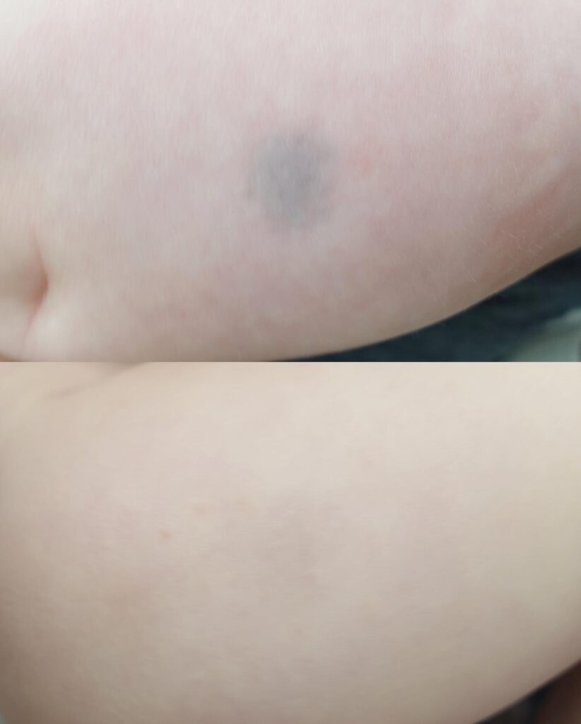 異所性蒙古斑の症例