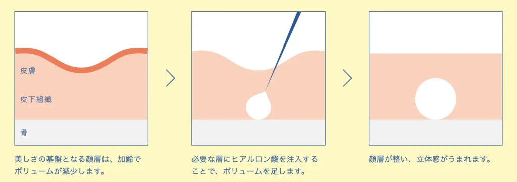ヒアルロン酸注入の流れ