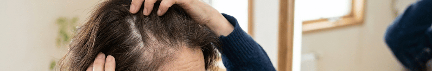 女性の薄毛・抜け毛
