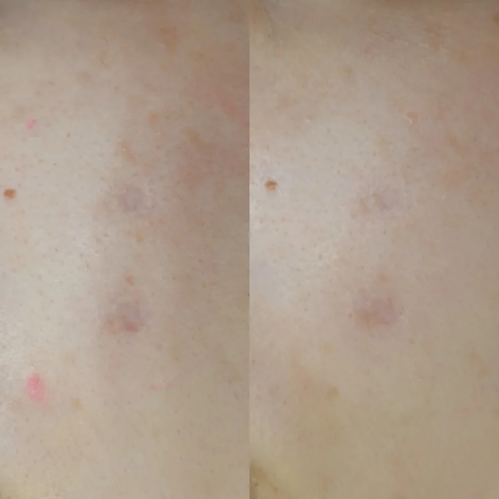 ほくろ除去後のへこみに対する当院での症例（キュアジェット単独）