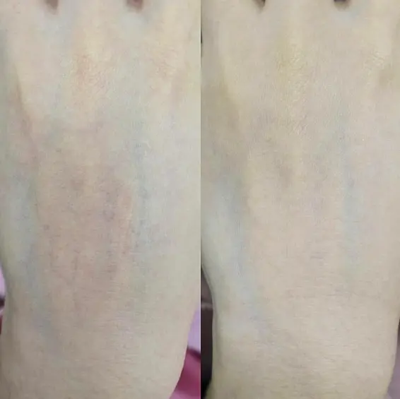 当院での症例｜手の甲の毛細血管拡張に対するダーマV治療
