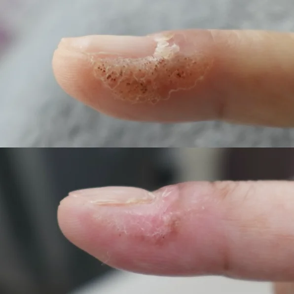 当院での症例｜ウイルス性イボのダーマVの症例