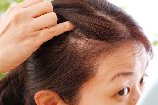 女性の薄毛
