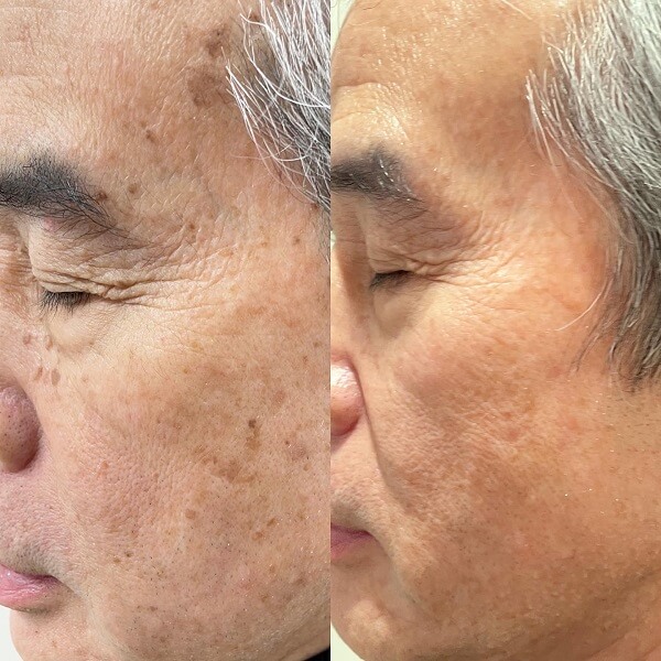 症例写真 - 老人性イボ