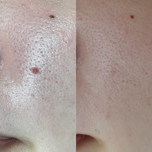 症例写真 - 血管線維腫