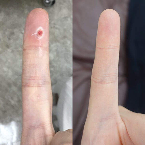 症例写真 - 血管拡張性肉芽腫