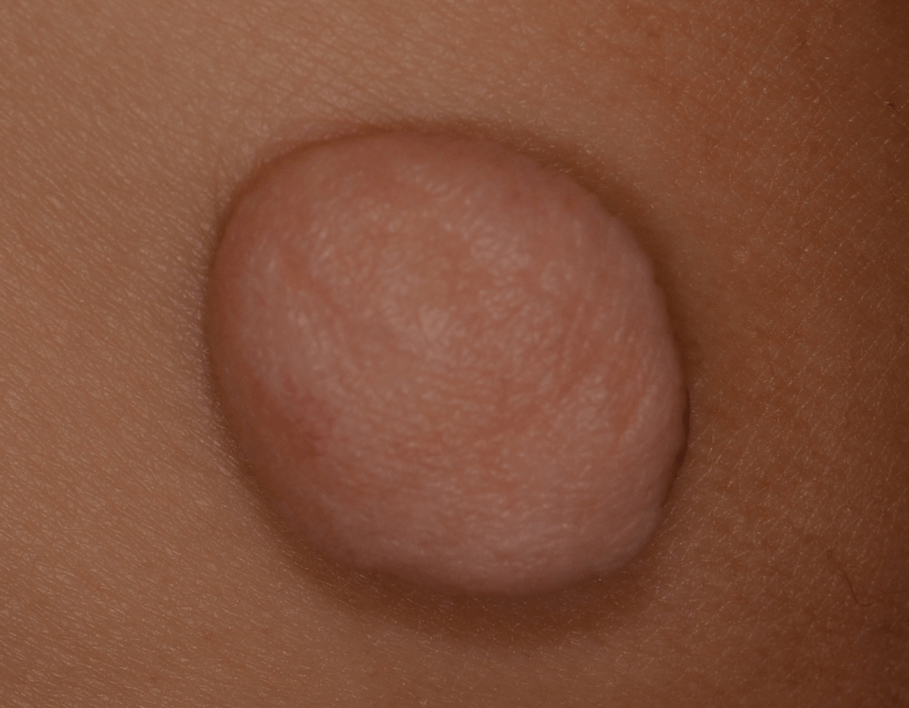 症例画像(大型のおしりの軟性線維腫)