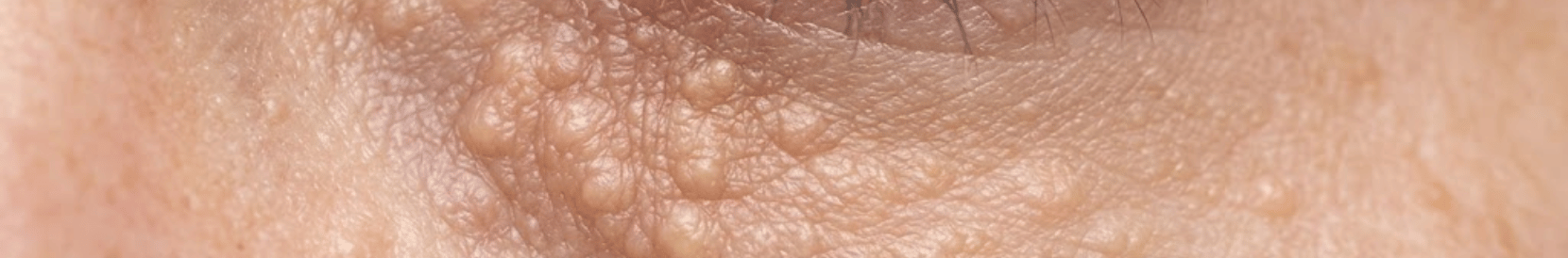 汗管腫