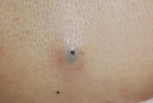 粉瘤