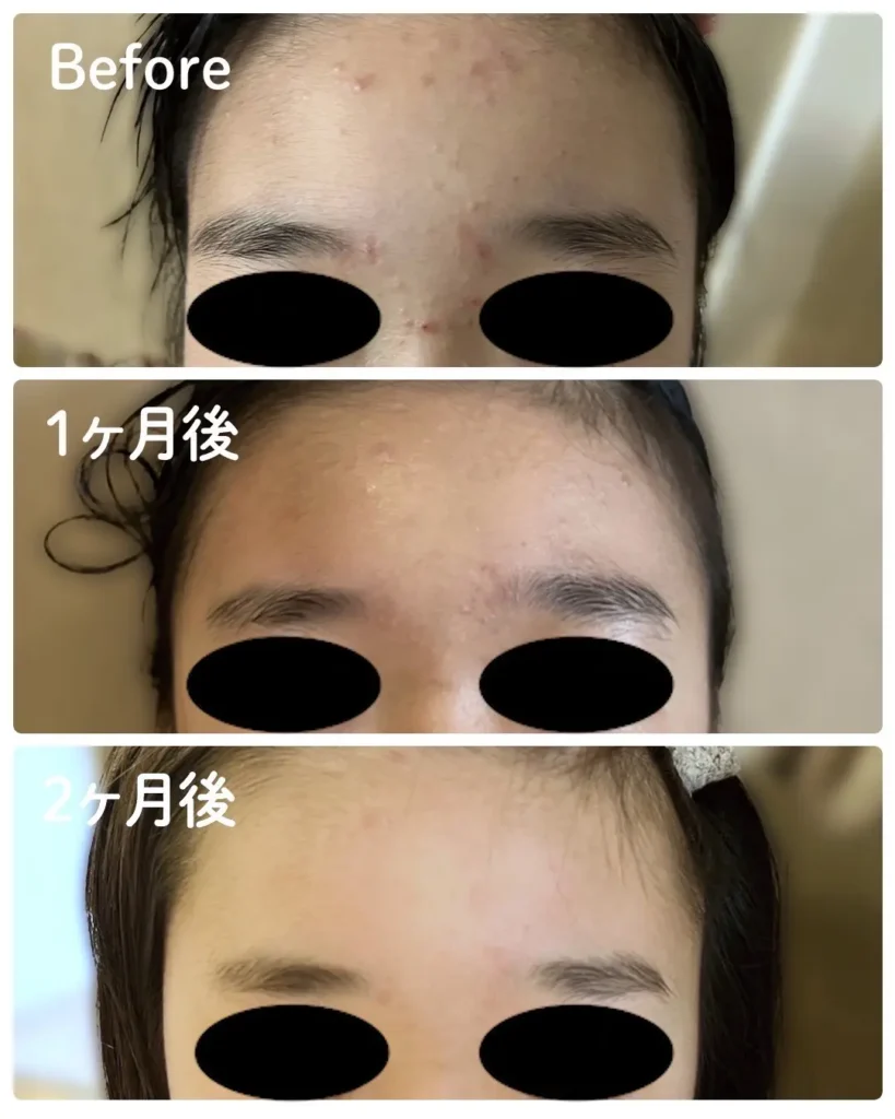 「ベーシックケアAZをニキビに使用した症例」