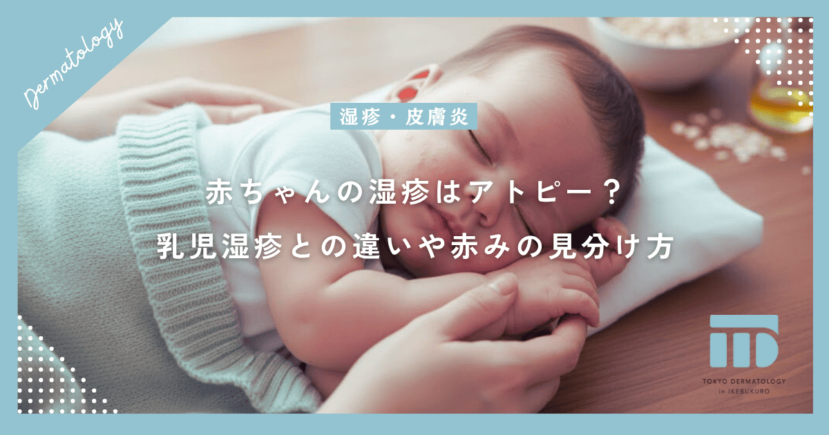 赤ちゃんの湿疹はアトピー?乳児湿疹との違いや長引く赤みの正しい見分け方