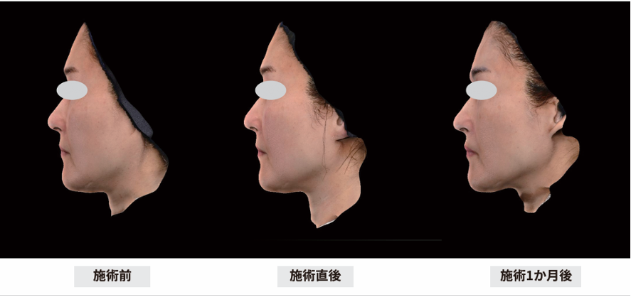 デンシティ アルファチップ 50代女性 症例（施術前・施術直後・施術1か月後）