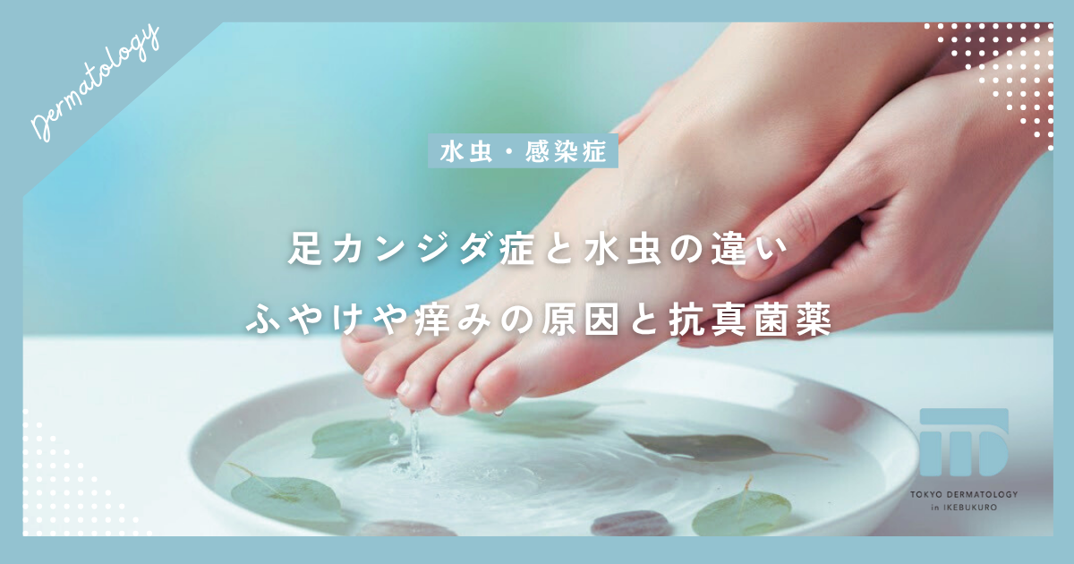 足カンジダ症と足白癬(水虫)の違い!指の間のふやけや痒みの原因と正しい抗真菌薬