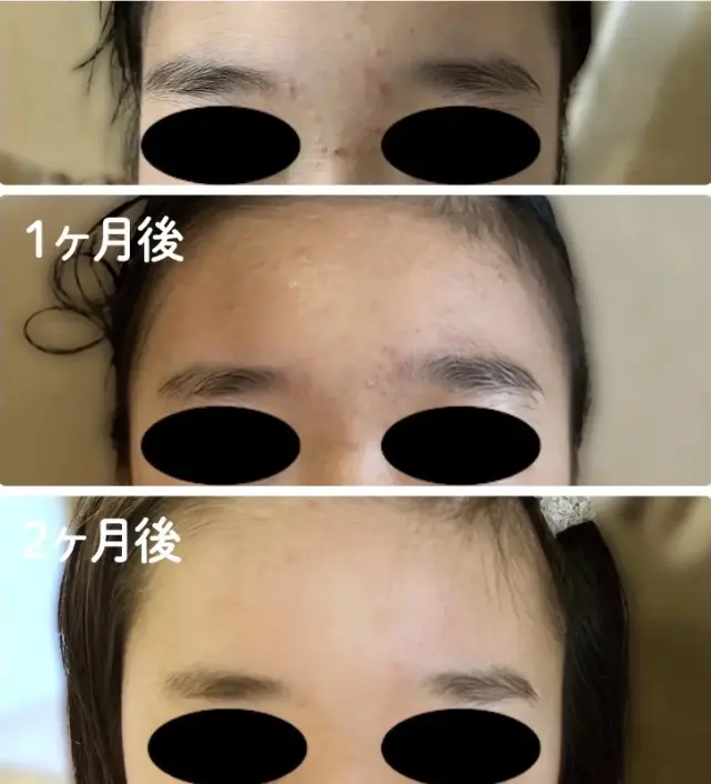 ベーシックケアAZをニキビに使用した症例（額のニキビ：使用前・1ヶ月後・2ヶ月後）