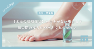 【水虫の初期症状】かゆみがない場合も？指の間の皮むけや小さな水ぶくれのサイン