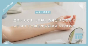 湿疹とたむし（白癬）の見分け方とは？ステロイドで悪化する前の正しい対処法