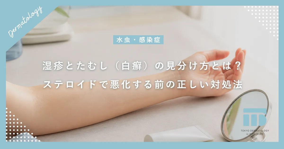 湿疹とたむし（白癬）の見分け方とは？ステロイドで悪化する前の正しい対処法