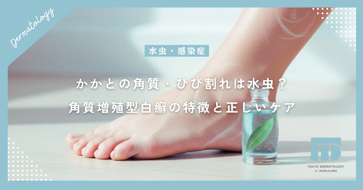 かかとの角質・ひび割れは水虫？ガサガサした角質増殖型白癬の特徴と正しいケア