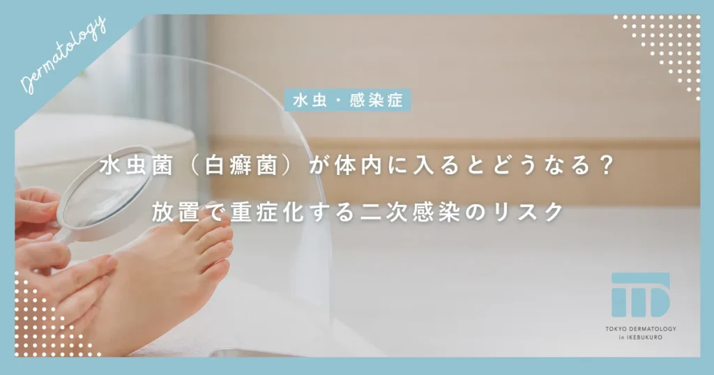 水虫菌（白癬菌）が体内に入るとどうなる？放置で重症化する二次感染のリスク