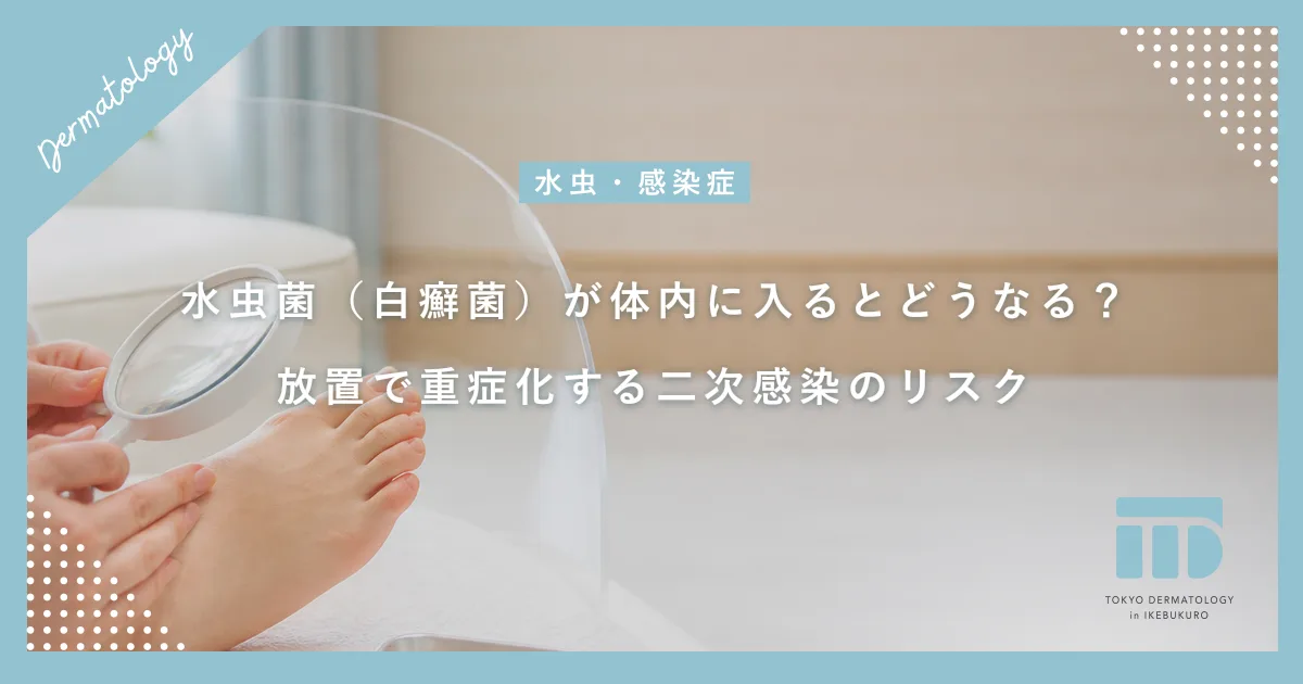 水虫菌（白癬菌）が体内に入るとどうなる？放置で重症化する二次感染のリスク