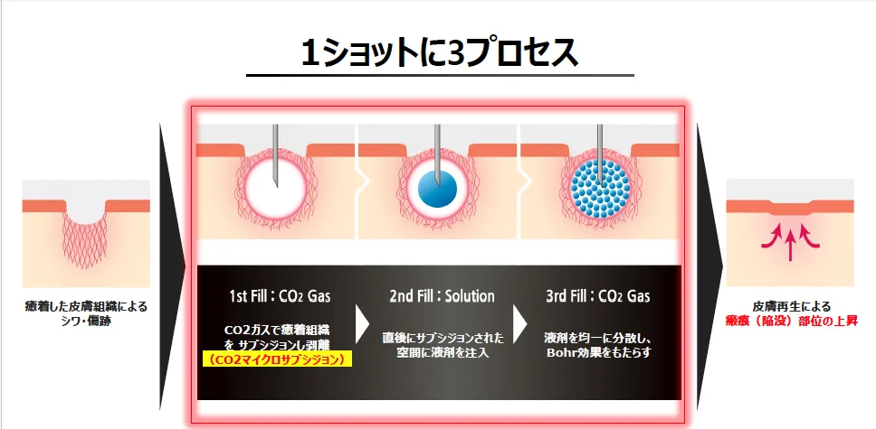 トライフィルプロの3プロセス。炭酸ガスで癒着した皮膚組織を剥離し、できた空間に薬剤を注入して、再度炭酸ガスで薬剤を均一に拡散する流れの図解